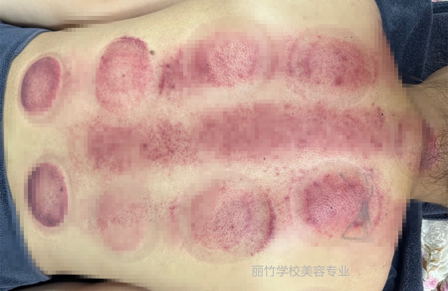 拔火罐的顏色代表什么？南寧美容美體專業(yè)實(shí)訓(xùn)