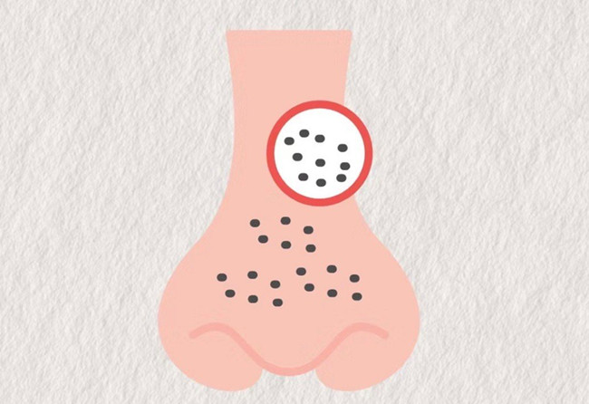 廣西皮膚管理師：面對(duì)嚴(yán)重的黑頭應(yīng)該怎么辦？